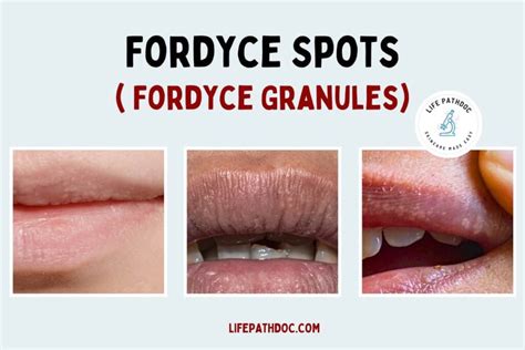 Fordyce Spots: Identification, Causes & Treatment